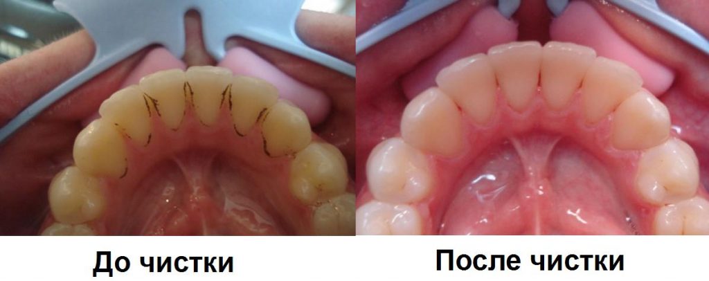 Air flow чистка зубов до и после фото